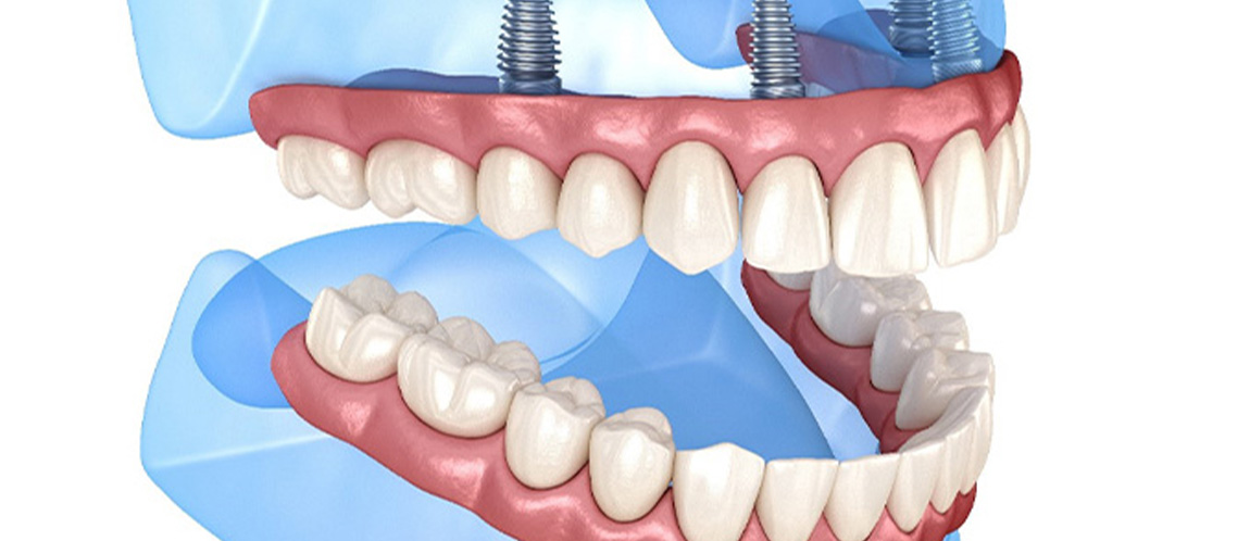 Diagram showing how All-on-4 dental implants in Albuquerque work