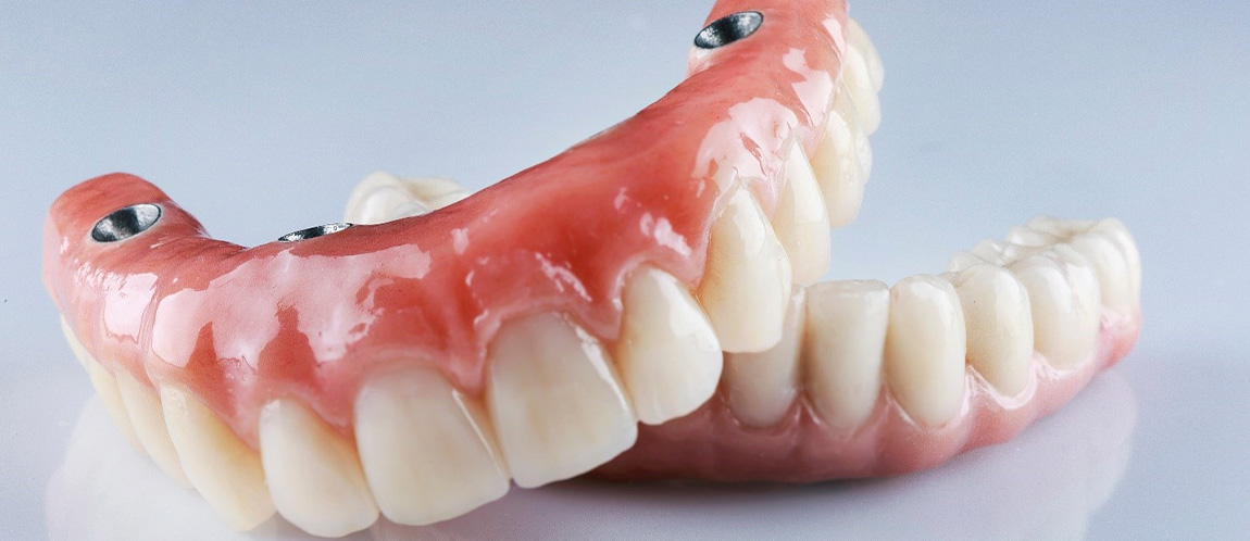 All-on-4 denture resting on top of standard denture