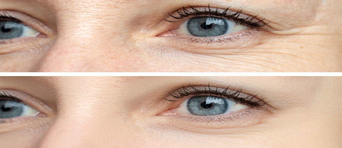 Close up of eyes before and after wrinkle removal