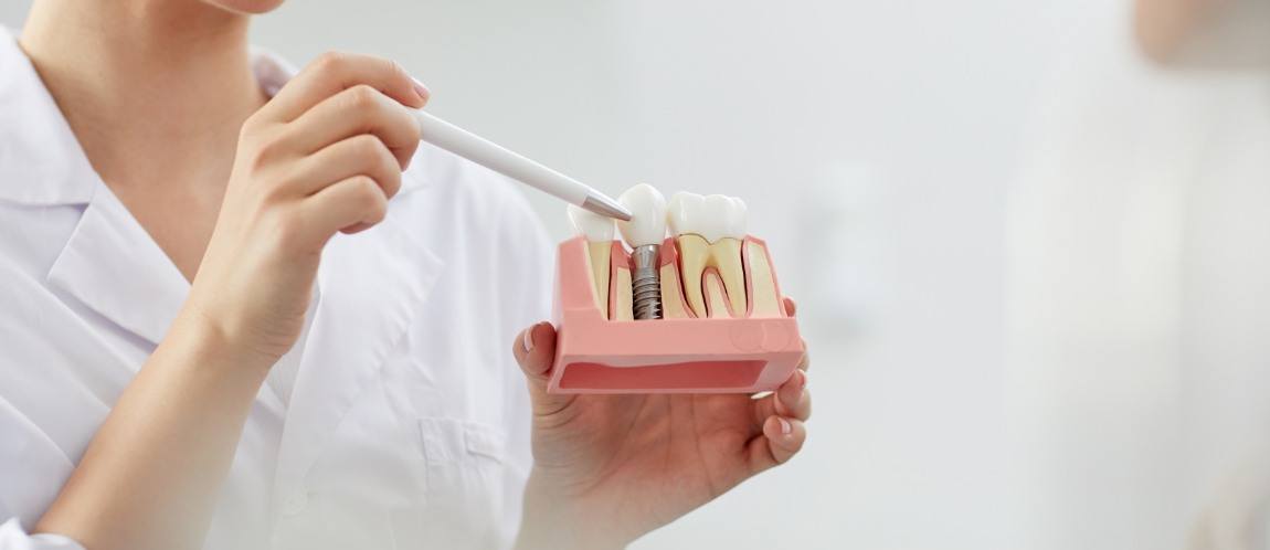 Dentist pointing to model of dental implant