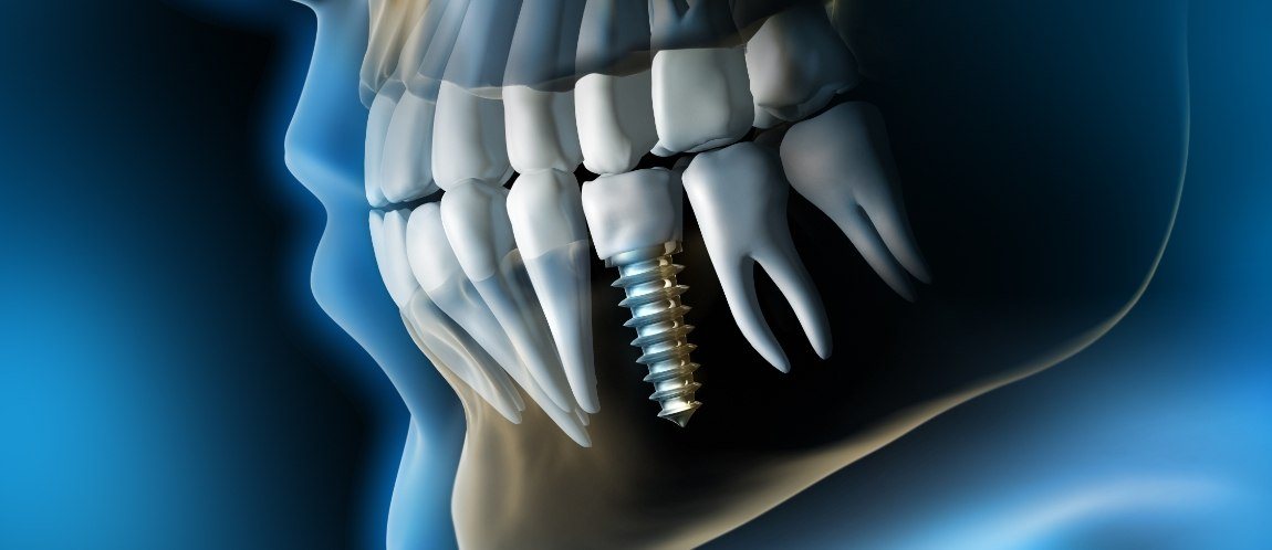 Animated smile with dental implant supported dental crown