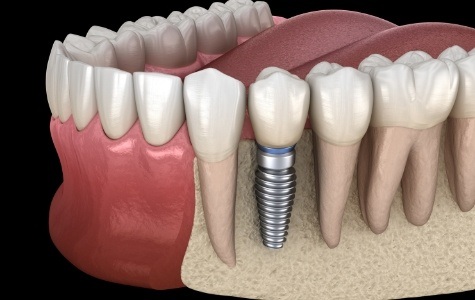 Animated dental implant with dental crown