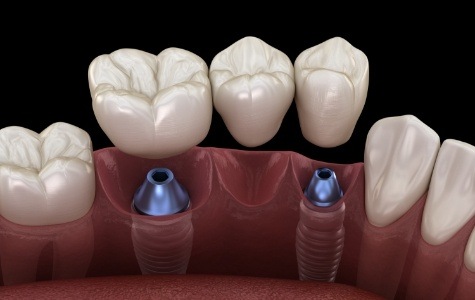 Animated dental bridge on two dental implants