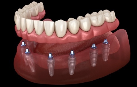 Animated implant denture on six implants