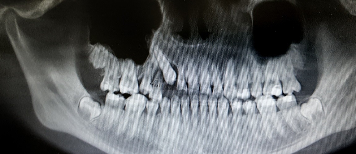 X ray of smile with impacted wisdom tooth