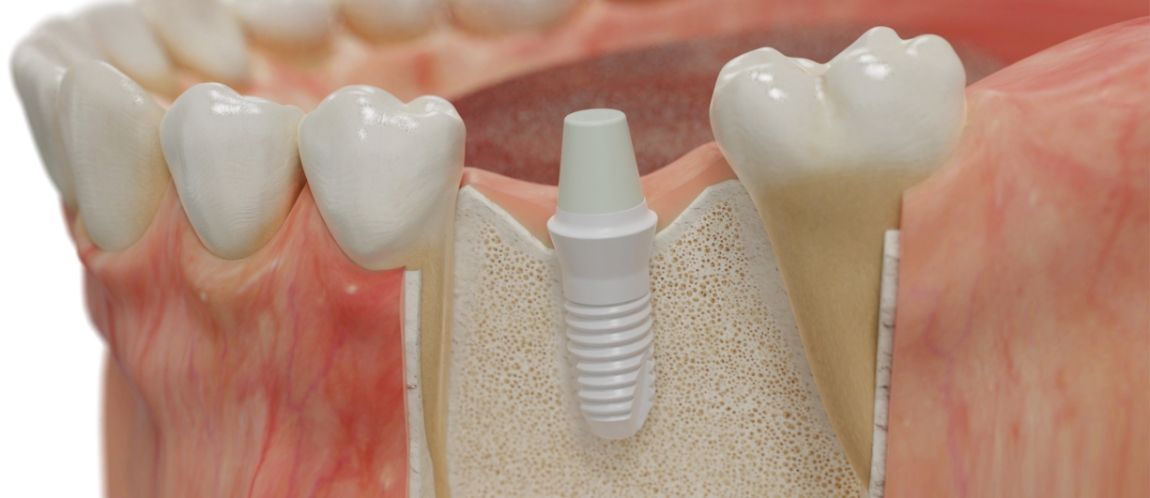 Model smile with bone graft supporting dental implant post