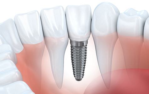 Illustrated dental implant in lower arch