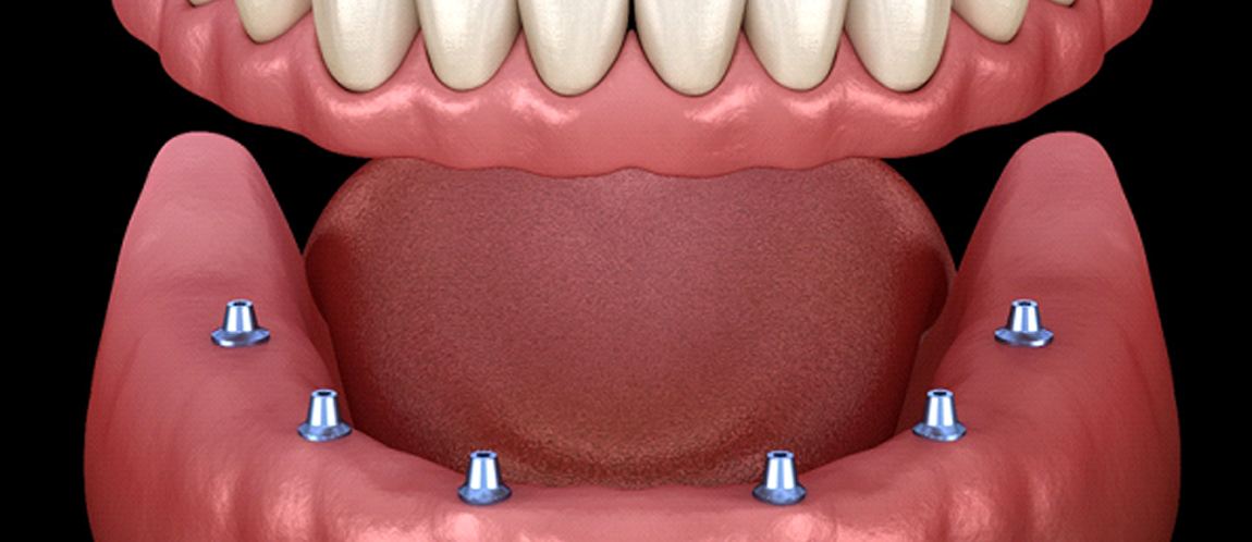 Diagram of implant dentures in Albuquerque