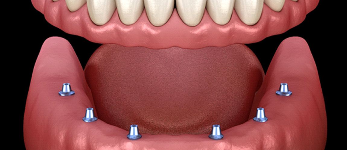 Diagram of implant dentures