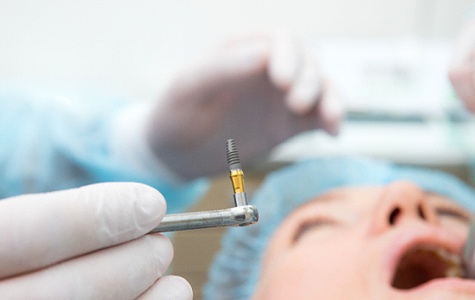 Oral surgeon placing dental implants in Albuquerque, NM