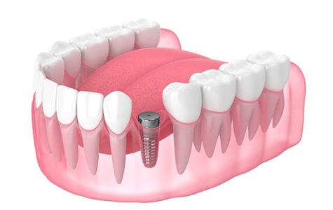 Illustration of dental implant during osseointegration