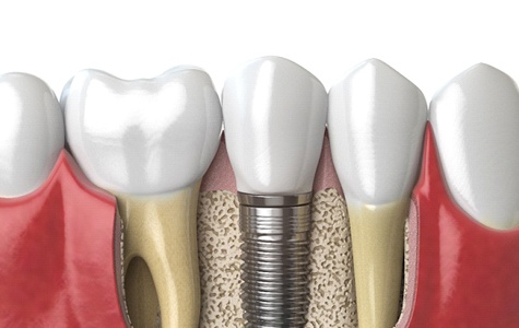 Illustration of dental implant after final restoration has been placed