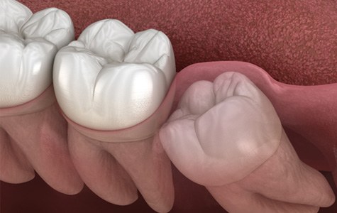 Illustrated impacted wisdom tooth