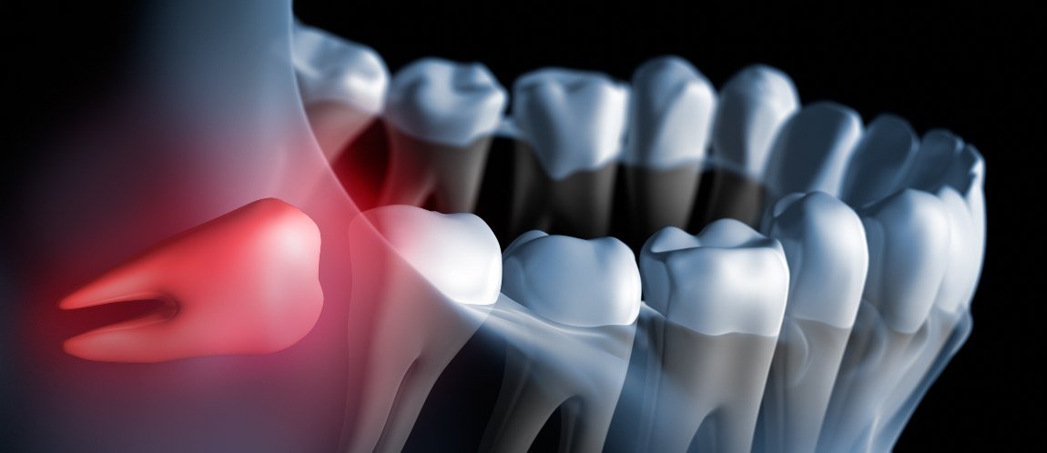 Animated smile with impacted wisdom tooth